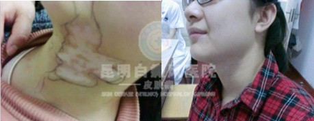 白癜风的病因有哪些?