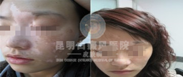 引发面部白癜风的原因