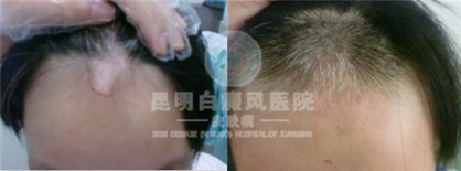 白癜风的致病因素是哪些