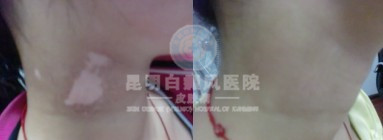 诊断白癜风的重要依据有哪些呢