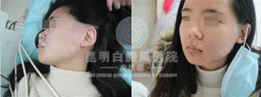 引发老年白癜风的原因是什么