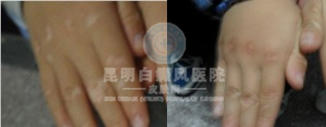 白癜风早期能治愈吗