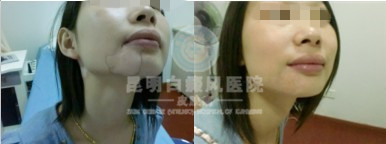 白癜风治疗的误区?