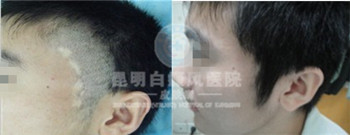 白癜风患者吃什么好?