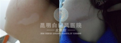 脸部白癜风能治好吗?