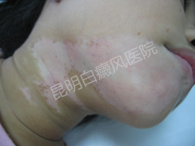 女性患白癜风在怀孕过程中该注意什么?