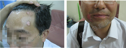 男性1年白癜风在我院3个月康复