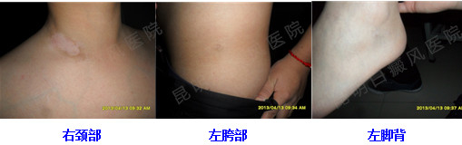 2年的白癜风在我院3个月治好