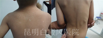 背部白癜风会出现什么症状