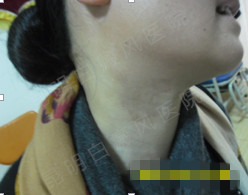 40岁女性颈部白癜风10余年