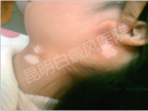 女性白癜风患者怎样调节内分泌?