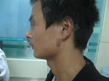 男性耳部局限型白癜风2年