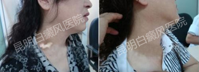 白癜风对女性朋友的影响有哪些?