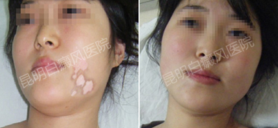 女性白癜风怎么治疗呢?