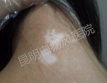 女性白癜风患者最为关心的三大问题