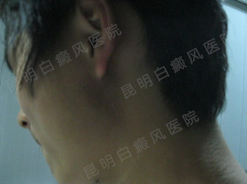 男性耳部局限型白癜风2年