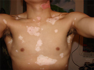 胸部白癜风生活调理