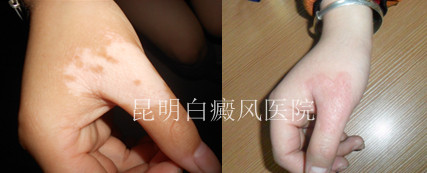 双手白癜风怎样治疗好?
