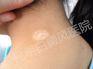 青少年不良的生活习惯易患白癜风