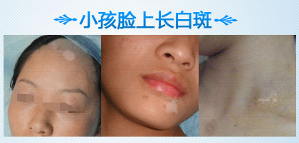 小孩脸上有白点 危害很大