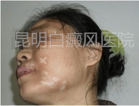 易患散发型白癜风的人群有哪几种?