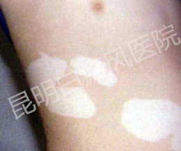 男性白癜风的诱因有哪些呢?