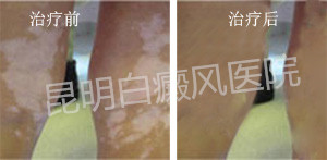 散发型白癜风会有哪些危害?