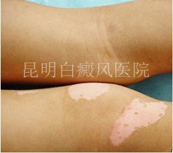 腿部白癜风患者需注意事项