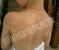 青少年患上白癜风的原因是什么?