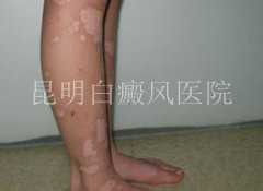 什么原因导致腿部白癜风扩散?