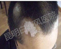 白癜风对男性患者的伤害有多深?