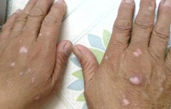 手部白癜风是由什么原因导致的?