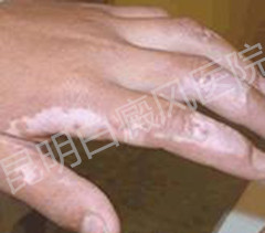 男性白癜风的预防方法是什么?