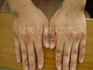 治疗肢端型白癜风四大注意事项