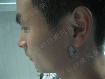 皮肤发白就是患有白癜风了吗?