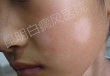 男性白癜风(白斑)患者怎么保养?