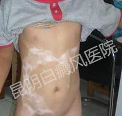 儿童白癜风病发后的危害?