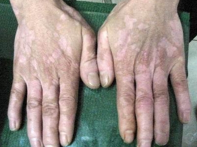 老年白癜风怎样预防复发?