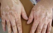 老年白癜风的危害有哪些?