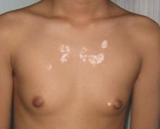 局限性白癜风的治疗方法有哪些?