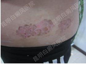 26岁女性腹部患白癜风3年