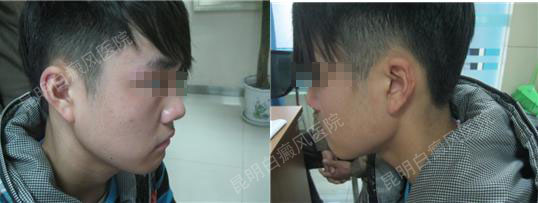 青少年面部白癜风4个月