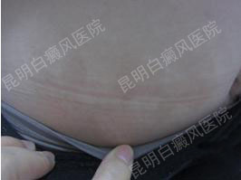 26岁女性腹部患白癜风3年