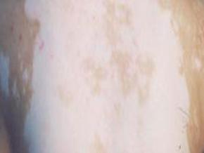 泛发型白癜风有什么症状?