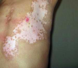 节段型白癜风有何临床表现?