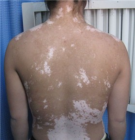 成人白癜风治疗要注意哪些?