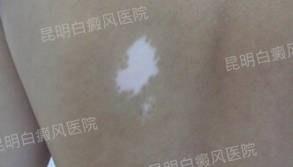 坚定乐观勇敢,战胜白斑病魔