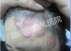 7年康复梦,祛白辛酸史