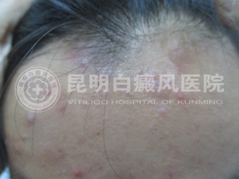 19岁男子面部白斑两年