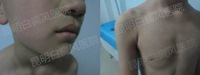 男胸部、颈部白斑一年半